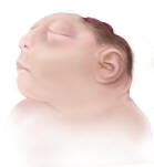 Drawing of child with anencephaly