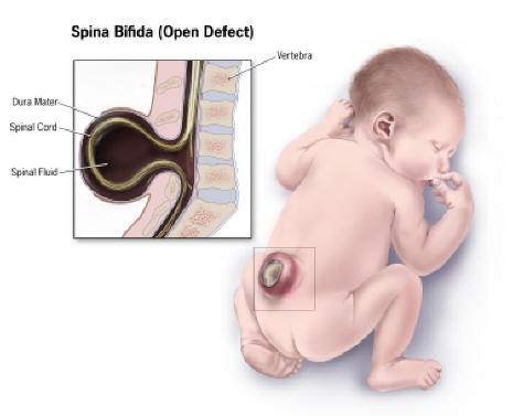 Drawing of child with Spina Bifida