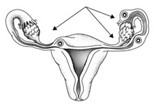 Image of Three Possible Sites of an Ectopic Pregnancy in DES Daughters