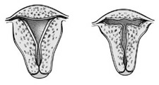 Image of the inside of a normal and a 'T' shaped uterus (right)
