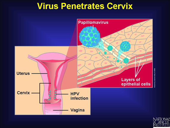 Virus Penetrates Cervix