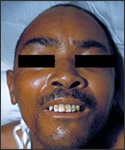 This patient presented with facial tetany. Note the contraction of the masseter and neck muscles.