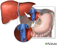 Ilustración de trasplante del hígado