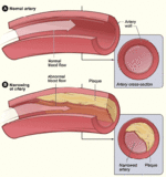 Illustration showing artery with atherosclerosis and a normal artery with normal blood flow. - Click to enlarge in new window.
