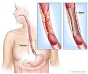 Esophageal stent. Shows cancer blocking esophagus. Insets show  enlarged area of cancer and a stent placed in the esophagus to keep it open.