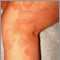 Ringworm, tinea corporis on the leg