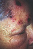 Shingles sores beginning to heal - Click to enlarge in new window.