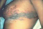 The dark scabs are part of the healing process. - Click to enlarge in new window.