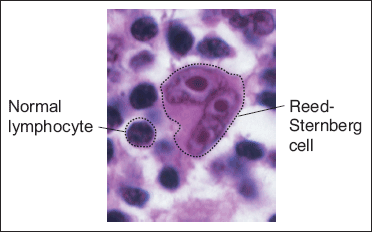 Reed-Sternberg cells are much larger than normal cells.