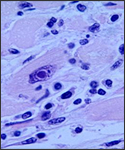 This micrograph reveals an intranuclear inclusion body in a heart section from a patient with diphtheria-related myocarditis.