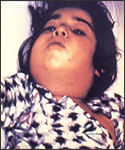 This child with diphtheria presented with a characteristic swollen neck, sometimes referred to as “bull neck”.