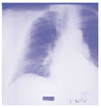 Análisis de laboratorio de fluidos o tejido de los pulmones