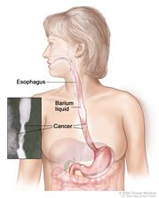 Barium swallow; shows barium liquid flowing through the esophagus and into the stomach.