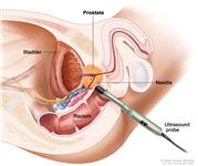 Transrectal biopsy; drawing shows a side view of the prostate, bladder, and rectum. Drawing also shows an ultrasound probe with a needle inserted into the rectum to remove a tissue sample from the prostate.