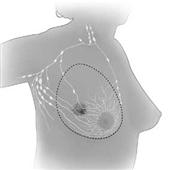 Total (simple) mastectomy; drawing shows removal of the breast and lymph nodes.