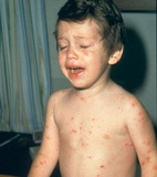 Child with chickenpox - Click to enlarge in new window.