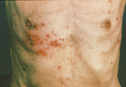 Shingles blisters on the chest of an eldery person - Click to enlarge in new window.