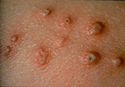 Close-up view of shingles blisters - Click to enlarge in new window.