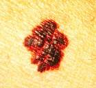 Photo of melanoma. - Click to enlarge in new window.