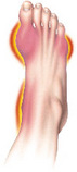 Drawing of foot with gout. - Click to enlarge in new window.