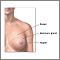 Extirpación del tumor de seno - Serie