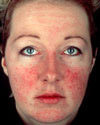 A persons face with Rosacea