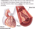 Heart Attack Illustration