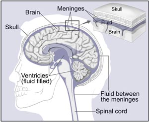 Illustration shows the skull, spinal cord, brain, meninges, ventricles, the fluid between the meninges, and the fluid in the ventricles.