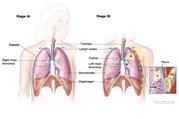 Two-panel drawing of stage I non-small cell lung cancer; first panel shows stage IA with cancer in one lung; the trachea, lungs, lymph nodes, right main bronchus, bronchioles, and diaphragm are also shown; second panel shows stage IB with cancer in the left lung and near the left main bronchus. The inset shows a close-up of the lung, chest wall, and pleura with cancer spreading from the lung into the innermost layer of the pleura.