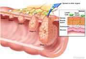 Colon cancer staging; shows tumors growing through layers of the colon wall for Stage 0, Stage I, Stage II, Stage III, and Stage IV colon cancer.  Inset shows serosa, muscle, submucosa and mucosa layers of the colon wall, and lymph nodes and blood vessels.