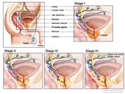 Prostate cancer staging; five  panel drawing showing a side view of normal  male  anatomy and closeup views of Stage I, Stage II, Stage III, and Stage IV  showing cancer growing from within the  prostate to nearby tissue and then to lymph nodes or other parts of the body.
