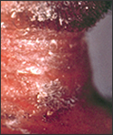 Diphtheria skin lesion on the neck.