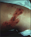 Shingles image.