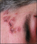 Fresh Shingles; facial rash with swollen eyelids.