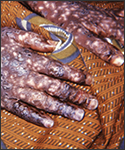 Smallpox lesions on the hands of a patient in Accra, Ghana.