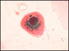 CMV infection of cell in urine