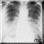 Mitral stenosis can also cause interstitial edema with a normal-sized cardiac silhouette.