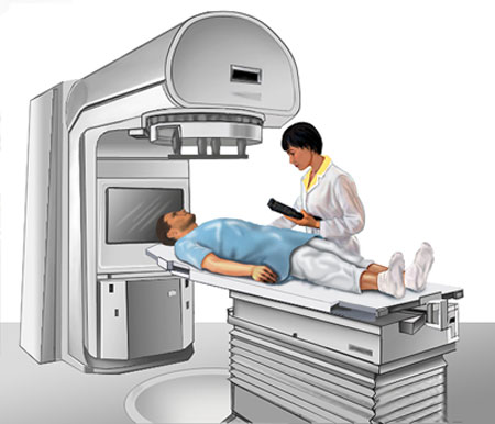 External Beam Radiation Therapy