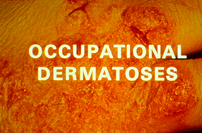 Occupational Dermatoses Introduction Slide