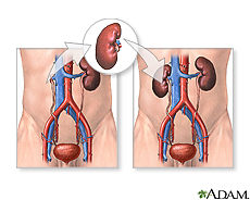 Ilustración de un trasplante de riñón 
