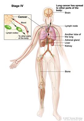 Stage IV non-small cell lung cancer; drawing shows parts of the body where cancer may spread from the lung where it started, including another lobe of the same lung, the other lung, the brain, lymph nodes, adrenal gland, liver, kidney, and bone; inset shows close-up of cancer spreading through the blood and lymph to other parts of the body.