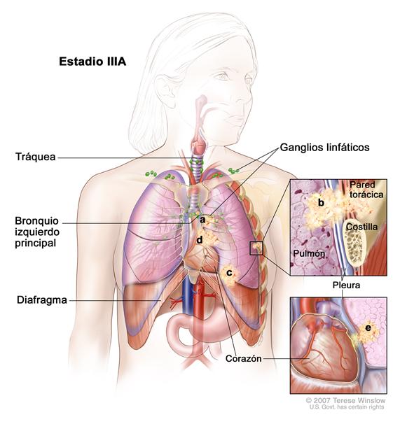 Cáncer de pulmón de células no pequeñas en estadio IIIA. El dibujo muestra el cáncer en los ganglios linfáticos, el bronquio izquierdo principal, la pleura, el diafragma y la pared torácica. Un recuadro muestra una ampliación  del cáncer que se disemina desde el pulmón hacia  la pleura y la pared torácica. Otro recuadro muestra una ampliación del cáncer que se disemina desde el pulmón hacia el  pericardio (la membrana que rodea el corazón).