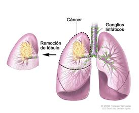 Lobectomía; el dibujo muestra los lóbulos de ambos pulmones, la tráquea, los bronquios, los bronquiolos y los ganglios linfáticos. El cáncer aparece en uno de los lóbulos. Se muestra el lóbulo que se extrajo al lado del pulmón de donde se sacó.