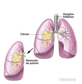 Neumonectomía; el dibujo muestra la tráquea, ganglios linfáticos y los pulmones con cáncer en un pulmón. Se muestra el pulmón con cáncer que se extrajo.