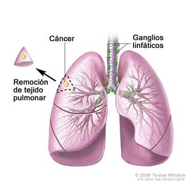 Remoción en cuña del pulmón; muestra la tráquea y los pulmones con cáncer en uno de los lóbulos del pulmón. Al lado de un pulmón, se muestra la parte del pulmón que se extrajo de este, la cual muestra a su vez una pequeña cantidad de tejido sano alrededor del sitio con cáncer.
