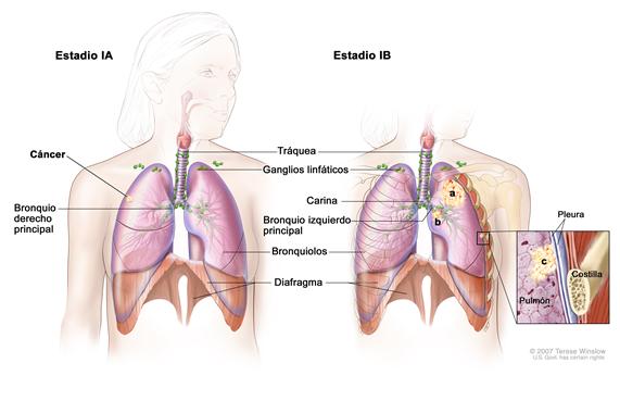 Dibujo en dos paneles del cáncer de pulmón de células no pequeñas en estadio I, el primer panel muestra el estadio IA con cáncer en un pulmón; también muestra la tráquea, los pulmones, los ganglios linfáticos, bronquio derecho principal, bronquiolos y diafragma; el segundo panel muestra el estadio IB con cáncer en el pulmón izquierdo y cerca del bronquio izquierdo principal.  El recuadro muestra una ampliación del pulmón, la pared torácica y la pleura con cáncer que se disemina desde el pulmón hacia la capa interna de la pleura.