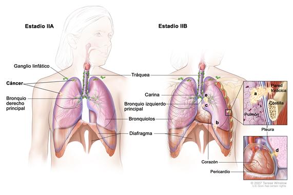 Dibujo en dos paneles del cáncer de pulmón de células no pequeñas en estadio II; el primer panel muestra el estadio IIA con cáncer en un pulmón y cáncer en varios ganglios linfáticos cercanos del mismo lado del pecho en que está el cáncer; también se muestra el bronquio derecho principal. El segundo panel muestra el estadio IIB con cáncer en la pared torácica, el diafragma, la pleura entre los pulmones y el bronquio izquierdo principal;  también se muestran la tráquea, la carina y los bronquiolos. Un recuadro muestra una ampliación del   cáncer que se disemina desde el pulmón hacia la pleura y la pared torácica; otro recuadro muestra una ampliación del cáncer que se disemina desde el pulmón hacia el pericardio (membrana que rodea el corazón).