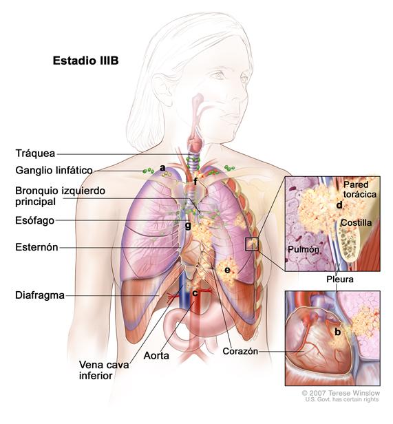 Cáncer de pulmón de células no pequeñas en estadio IIIB. El dibujo muestra el cáncer en los ganglios linfáticos, encima de la clavícula o los ganglios linfáticos del lado opuesto del pecho en que está el cáncer; también muestra el cáncer en la tráquea, el bronquio izquierdo principal, el esófago, el esternón, el diafragma, la vena cava inferior, la aorta, el corazón y la pared torácica. Un recuadro muestra una ampliación de la diseminación del cáncer desde el pulmón hacia el interior de la pleura y la pared torácica. Otro recuadro muestra una ampliación del cáncer que se disemina desde el pulmón hacia el  pericardio (la membrana que rodea el corazón) y el corazón.