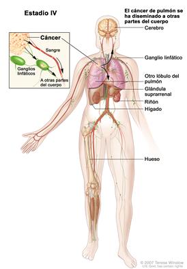 Cáncer de pulmón de células no pequeñas en estadio IV. El dibujo muestra las partes del cuerpo donde el cáncer podría diseminarse desde el pulmón donde comenzó; como por ejemplo, a otro lóbulo en el mismo pulmón, el otro pulmón, el cerebro, los ganglios linfáticos, la glándula suprarrenal, el hígado, el riñón y el hueso. El recuadro muestra una ampliación del cáncer que se disemina a través de la sangre y la linfa hacia otras partes del cuerpo.