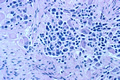 Pathology: Histology: Ganglioneuroblastoma